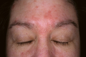 Аллергический дерматит контактного типа на лице