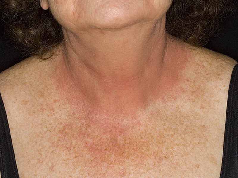 Аллергический дерматит контактного типа на шее