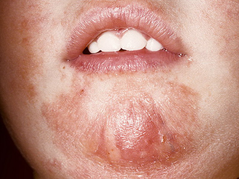Контактный дерматит на лице у ребенка