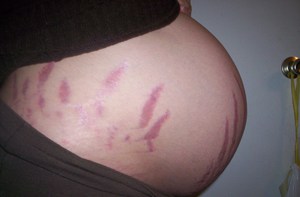 Растяжки на коже во время беременности - это частая проблема у женщин.