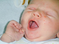 Опасны ли прыщи на лице у новорожденного
