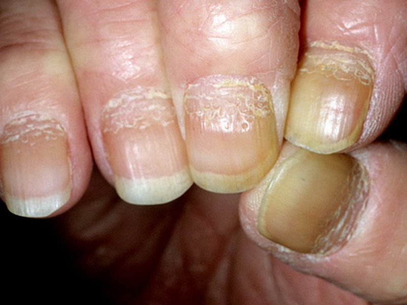 Как лечить псориаз ногтей