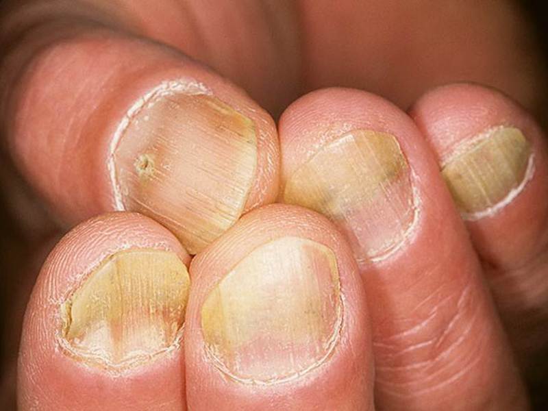 Причины псориаза на ногтях