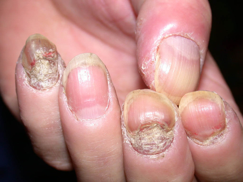Как лечить псориаз на ногтях рук