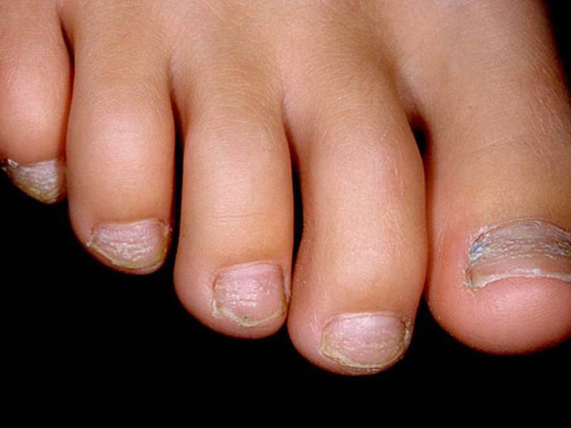 Как проявляется псориаз на ногтях
