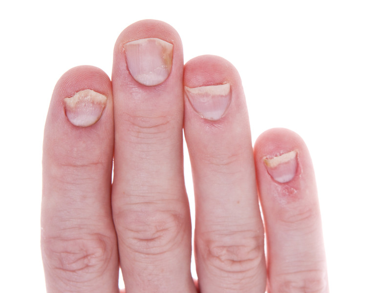 Как лечить псориаз на ногтях рук