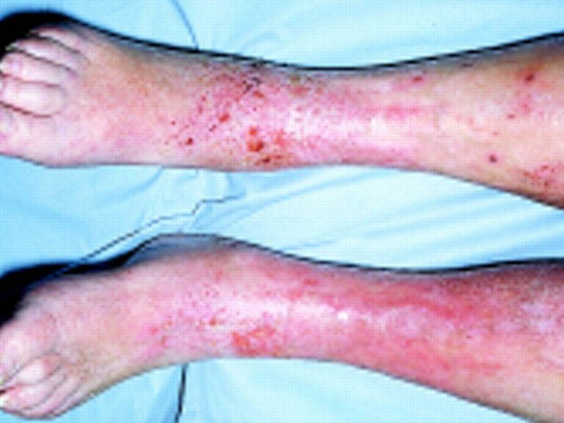 Степень заражения кожи ног